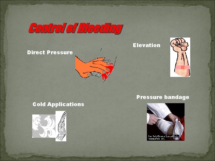 Control of Bleeding Direct Pressure Cold Applications Elevation Pressure bandage 