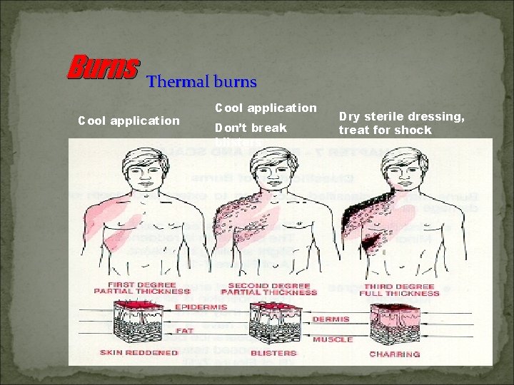 Burns Thermal burns Cool application Don’t break blisters Dry sterile dressing, treat for shock
