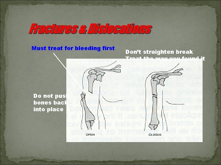 Fractures & Dislocations Must treat for bleeding first Do not push bones back into