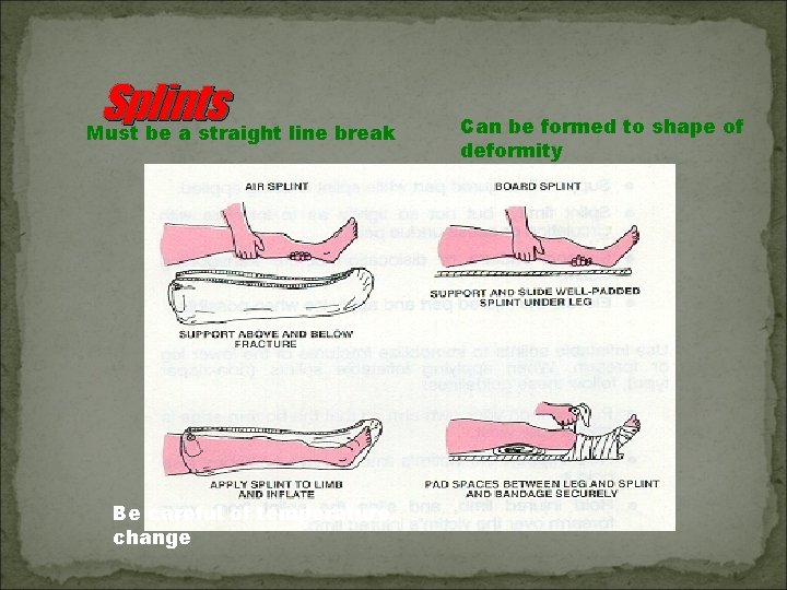 Splints Must be a straight line break Be careful of temperature change Can be