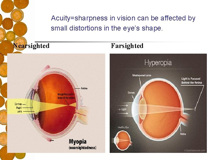 Acuity=sharpness in vision can be affected by small distortions in the eye’s shape. Nearsighted