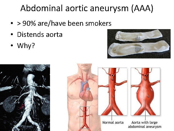 Abdominal aortic aneurysm (AAA) • > 90% are/have been smokers • Distends aorta •