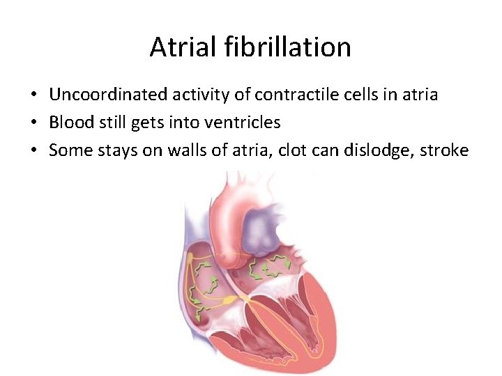 Atrial fibrillation • Uncoordinated activity of contractile cells in atria • Blood still gets