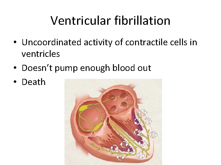 Ventricular fibrillation • Uncoordinated activity of contractile cells in ventricles • Doesn’t pump enough