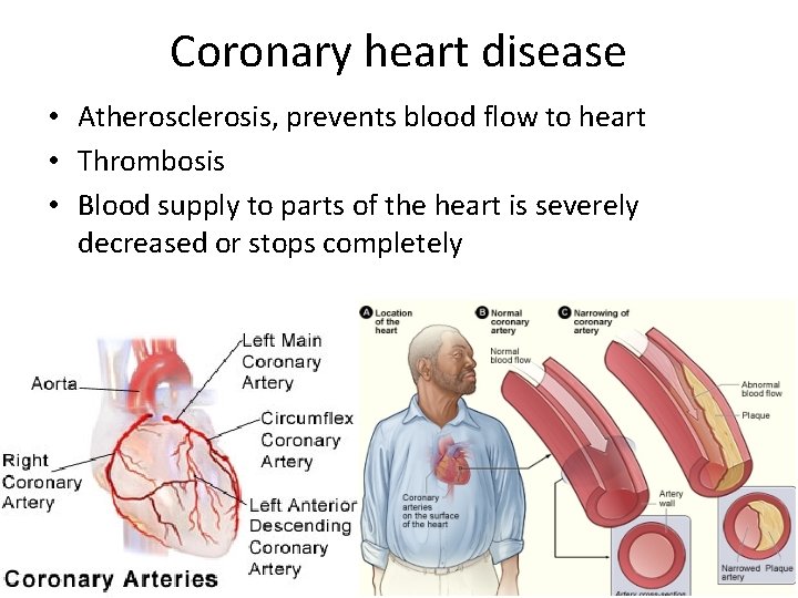 Coronary heart disease • Atherosclerosis, prevents blood flow to heart • Thrombosis • Blood