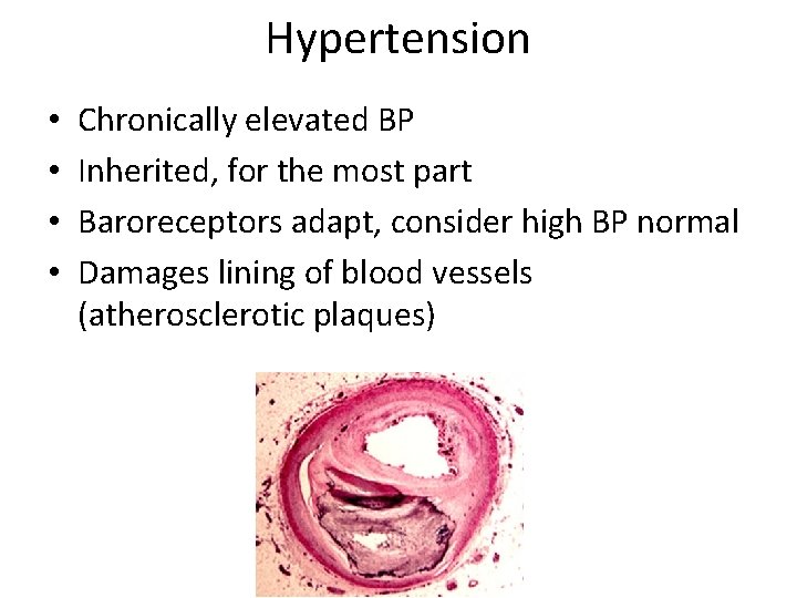 Hypertension • • Chronically elevated BP Inherited, for the most part Baroreceptors adapt, consider