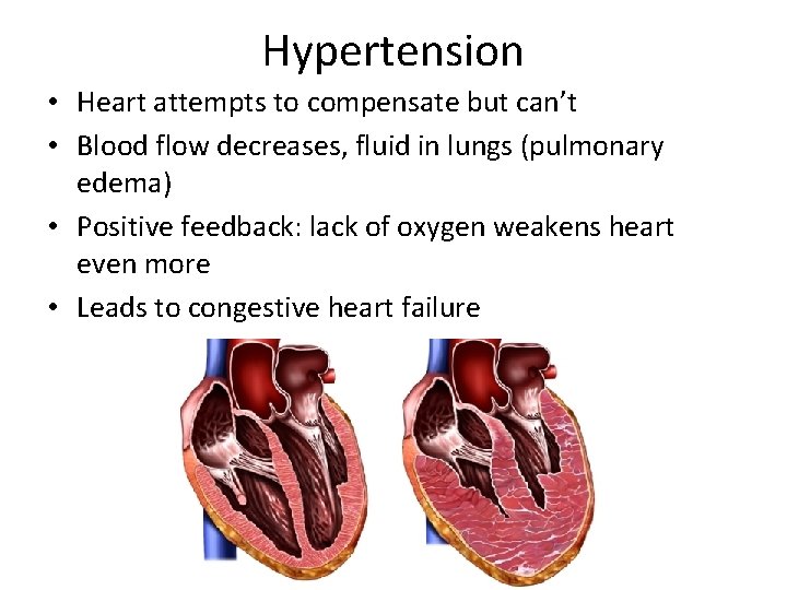 Hypertension • Heart attempts to compensate but can’t • Blood flow decreases, fluid in