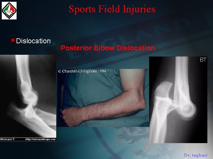 Sports Field Injuries Dislocation Posterior Elbow Dislocation Dr. taghavi 