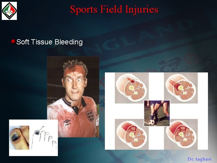 Sports Field Injuries Soft Tissue Bleeding Dr. taghavi 
