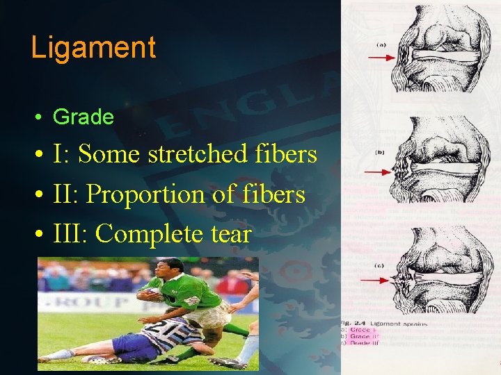 Ligament • Grade • I: Some stretched fibers • II: Proportion of fibers •