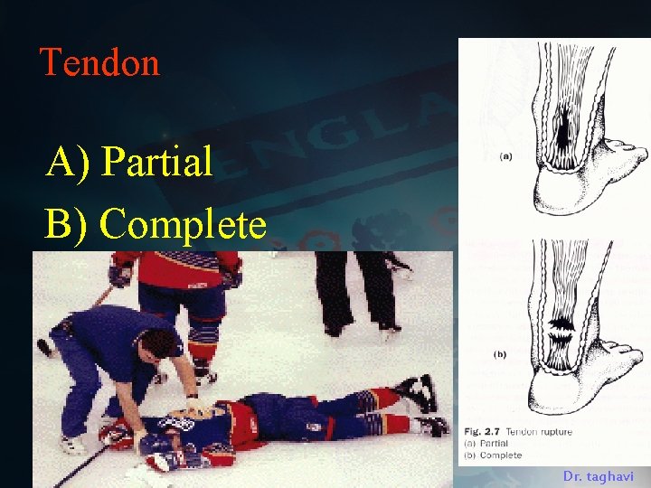 Tendon A) Partial B) Complete Dr. taghavi 