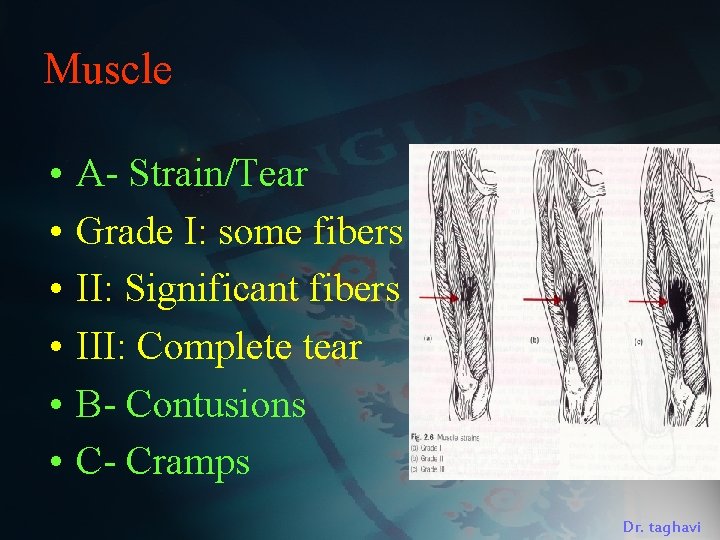 Muscle • • • A- Strain/Tear Grade I: some fibers II: Significant fibers III: