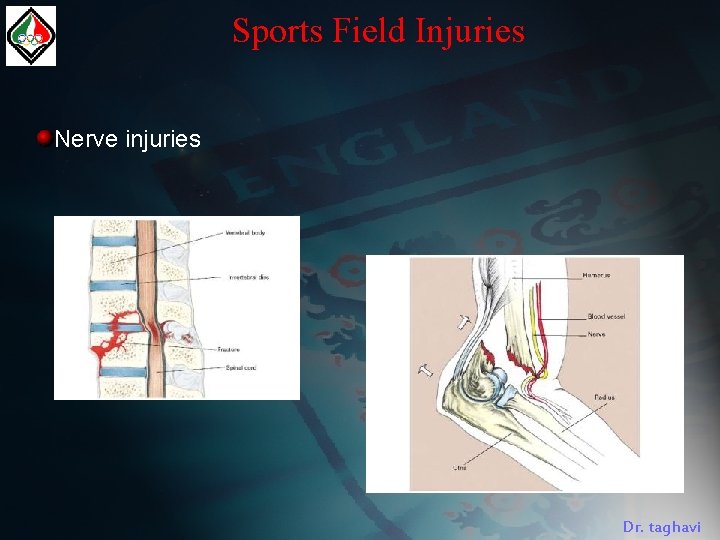 Sports Field Injuries Nerve injuries Dr. taghavi 