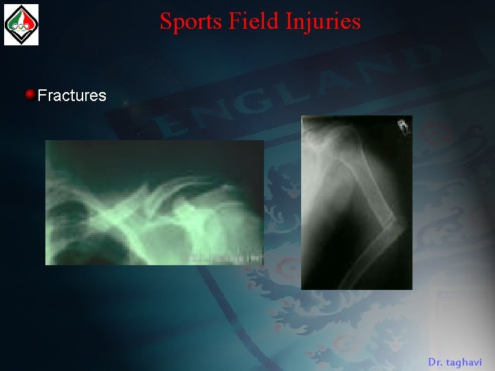 Sports Field Injuries Fractures Dr. taghavi 