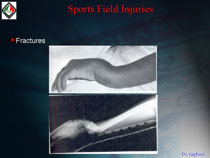 Sports Field Injuries Fractures Dr. taghavi 