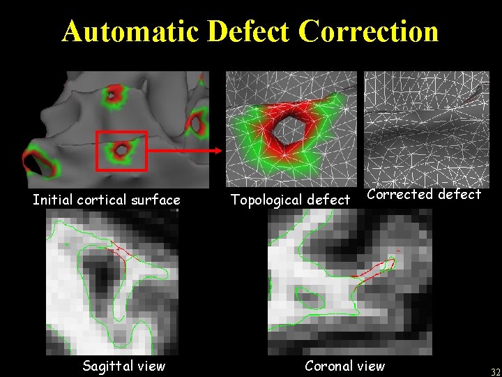 Automatic Defect Correction Initial cortical surface Sagittal view Topological defect Corrected defect Coronal view