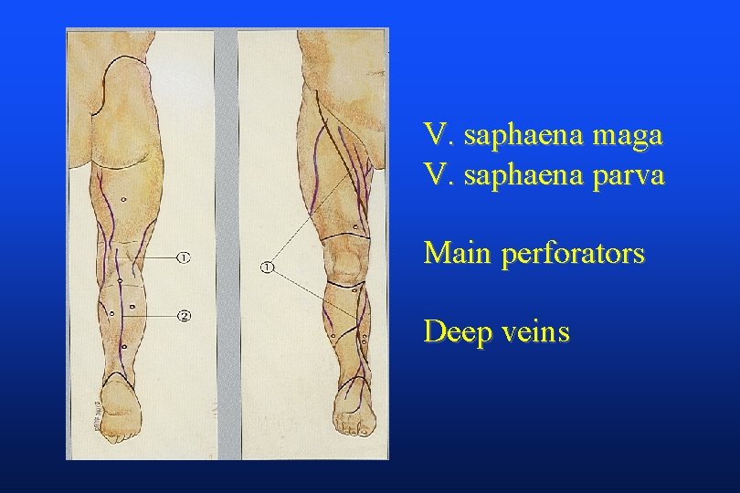 V. saphaena maga V. saphaena parva Main perforators Deep veins 