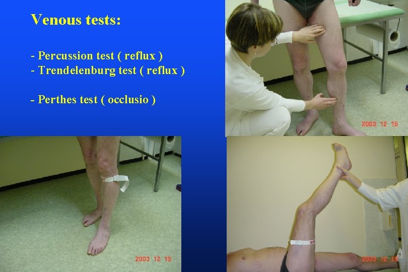 Venous tests: - Percussion test ( reflux ) - Trendelenburg test ( reflux )