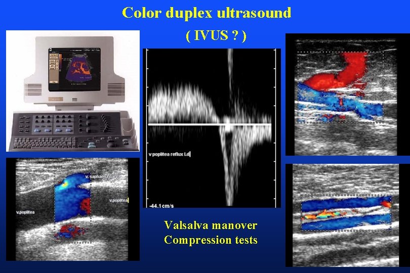 Color duplex ultrasound ( IVUS ? ) Valsalva manover Compression tests 