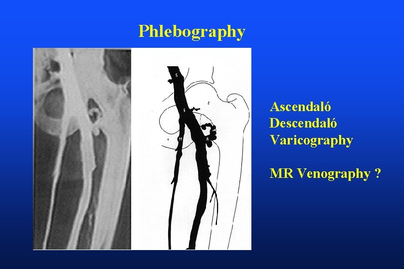 Phlebography Ascendaló Descendaló Varicography MR Venography ? 