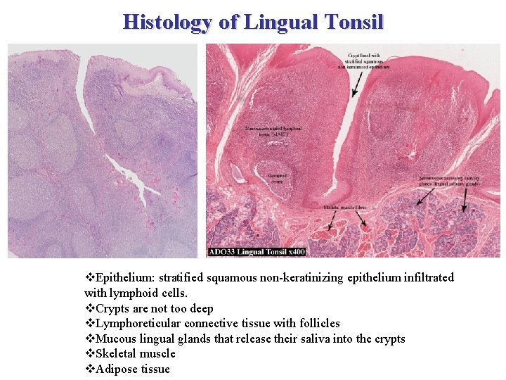 Histology of Lingual Tonsil v. Epithelium: stratified squamous non-keratinizing epithelium infiltrated with lymphoid cells.