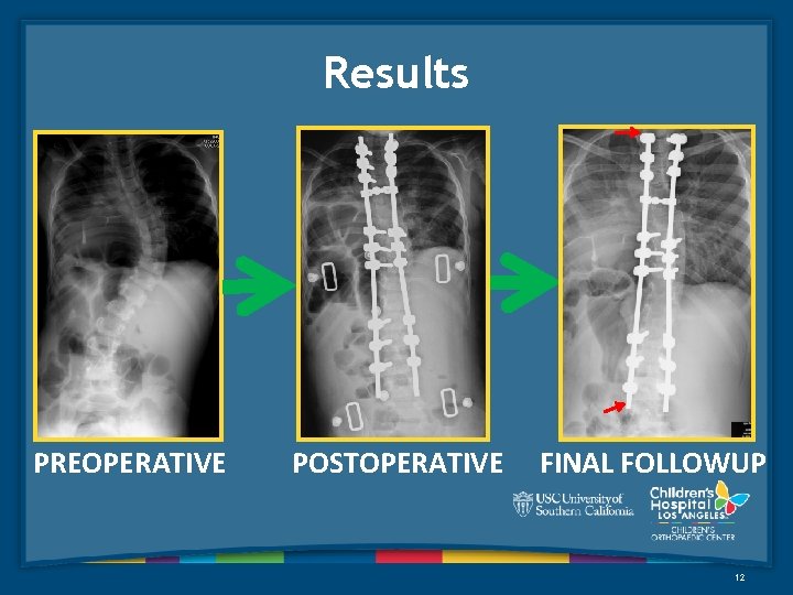 Results PREOPERATIVE POSTOPERATIVE FINAL FOLLOWUP 12 