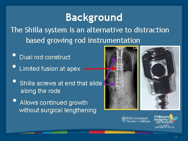 Background The Shilla system is an alternative to distraction based growing rod instrumentation •