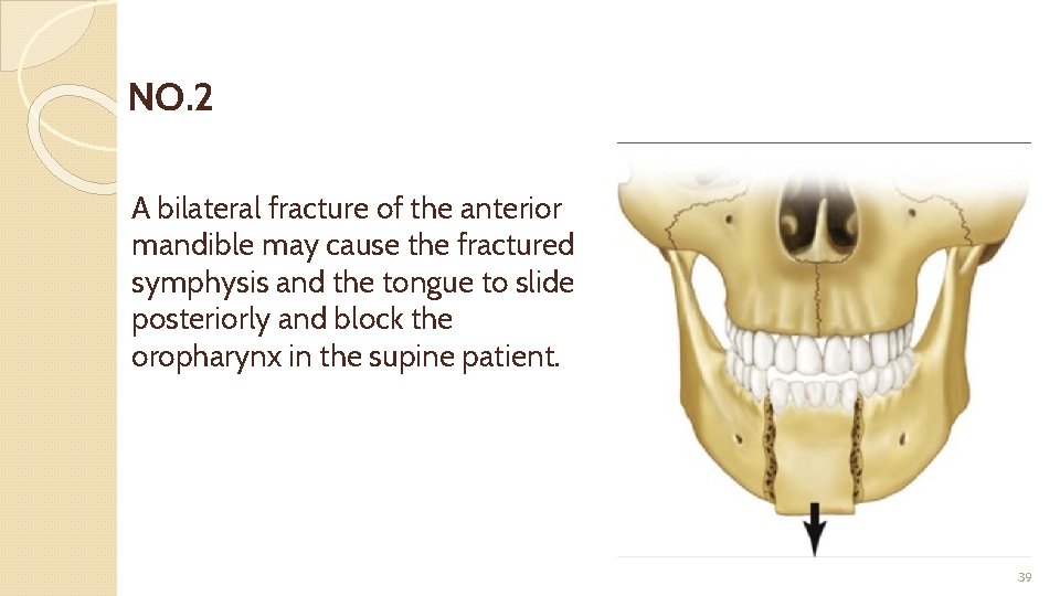 NO. 2 A bilateral fracture of the anterior mandible may cause the fractured symphysis