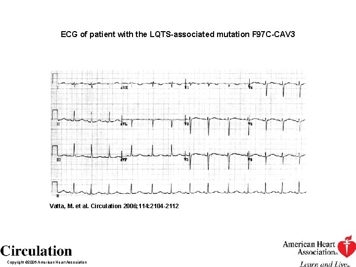 ECG of patient with the LQTS-associated mutation F 97 C-CAV 3 Vatta, M. et