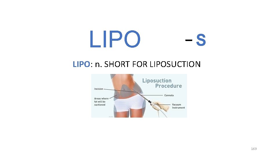 LIPO _ S LIPO: n. SHORT FOR LIPOSUCTION 169 LIPO _ S LIPO: n. SHORT FOR LIPOSUCTION 169