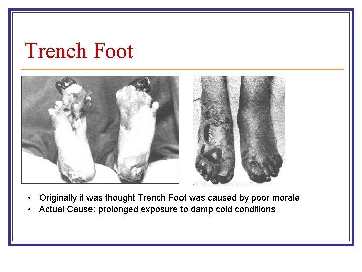 Trench Foot • Originally it was thought Trench Foot was caused by poor morale