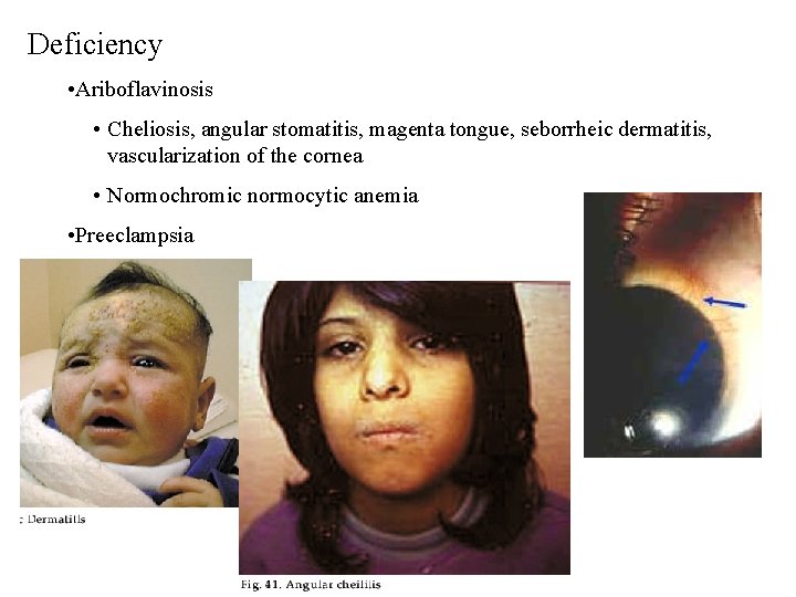 Deficiency • Ariboflavinosis • Cheliosis, angular stomatitis, magenta tongue, seborrheic dermatitis, vascularization of the