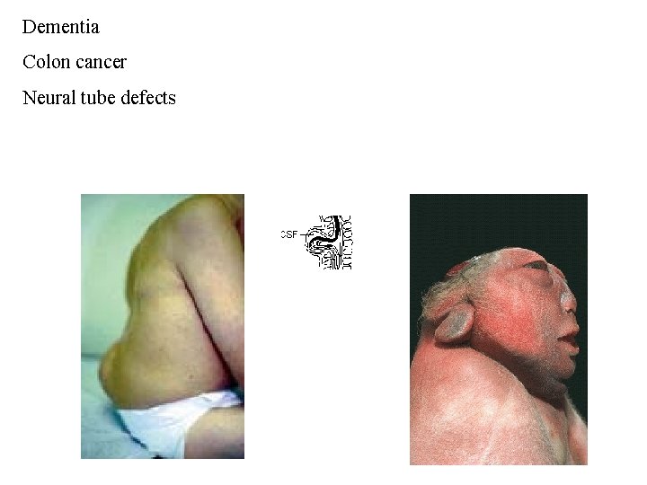 Dementia Colon cancer Neural tube defects 