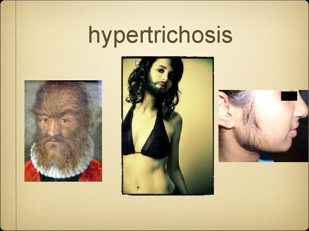 hypertrichosis 