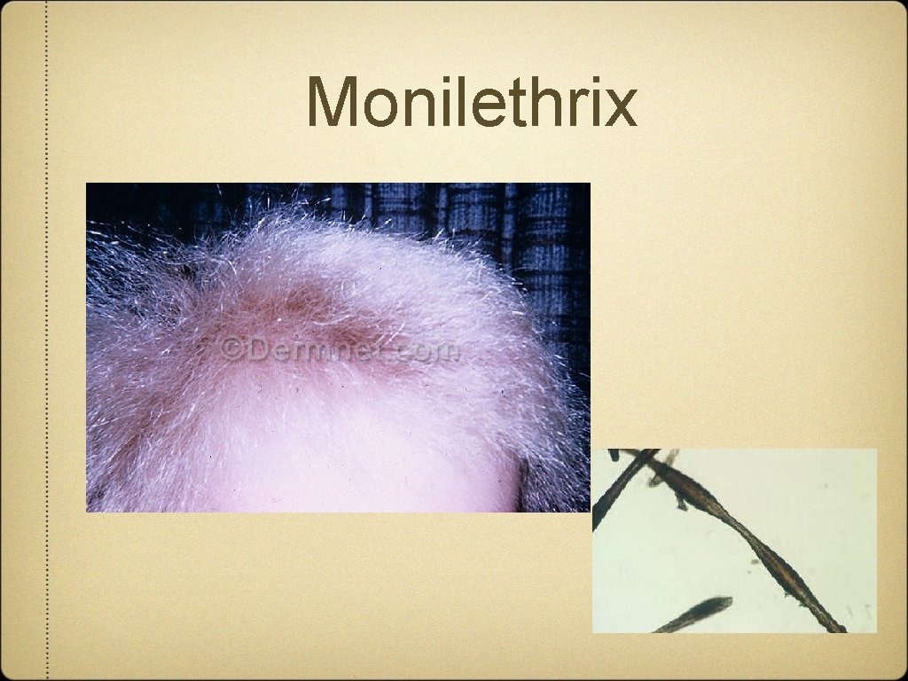 Monilethrix 