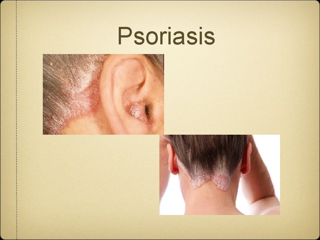 Psoriasis 