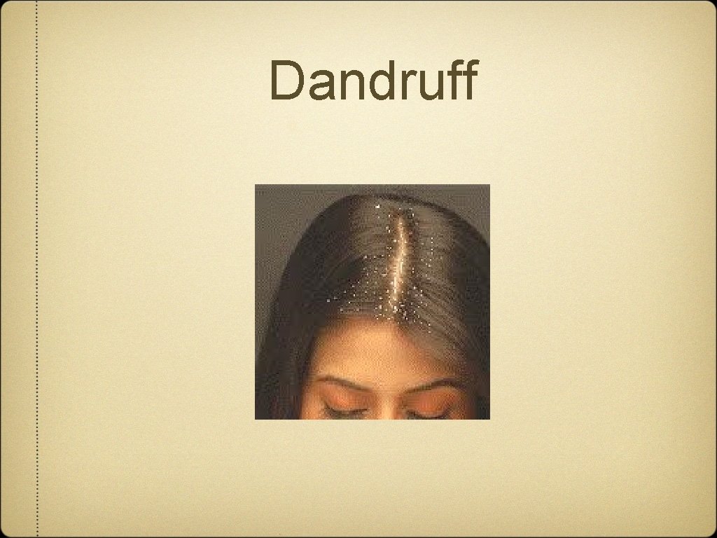 Dandruff 