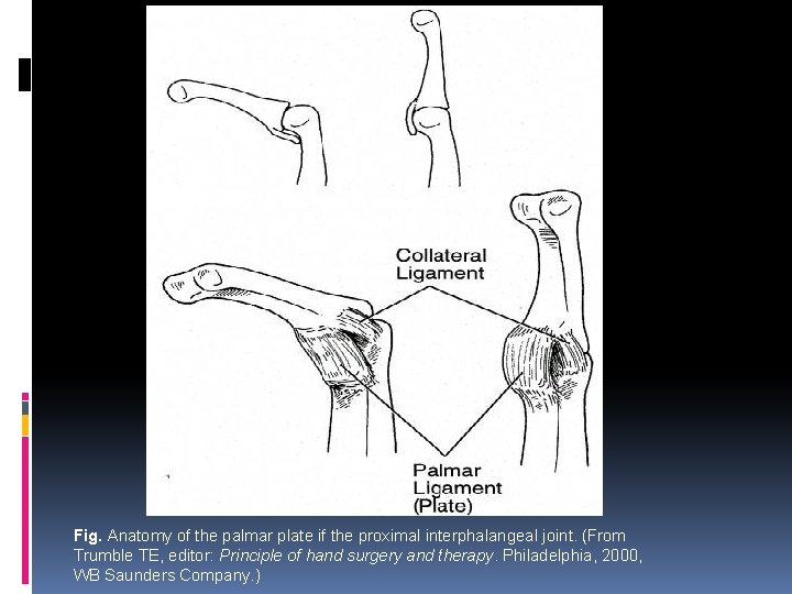 Fig. Anatomy of the palmar plate if the proximal interphalangeal joint. (From Trumble TE,