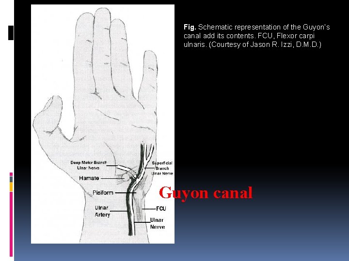 Fig. Schematic representation of the Guyon’s canal add its contents. FCU, Flexor carpi ulnaris.