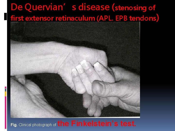 De Quervian’s disease (stenosing of first extensor retinaculum (APL. EPB tendons) Fig. Clinical photograph