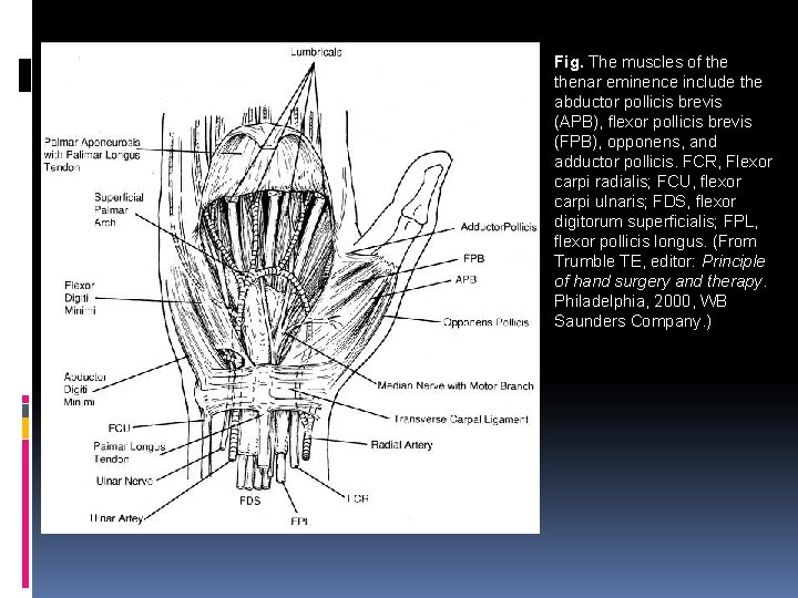 Fig. The muscles of thenar eminence include the abductor pollicis brevis (APB), flexor pollicis