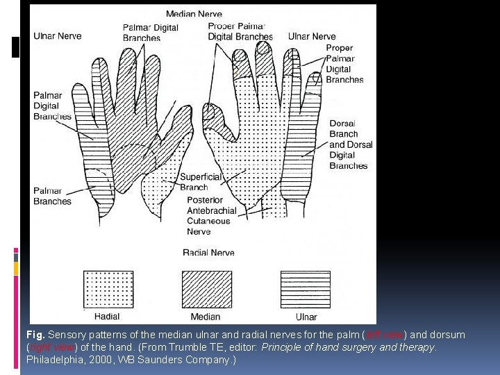 Fig. Sensory patterns of the median ulnar and radial nerves for the palm (left