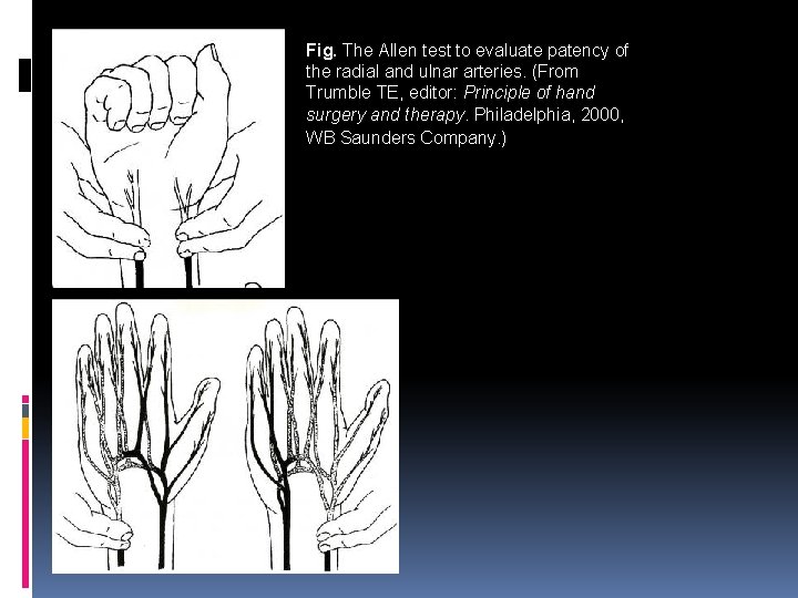 Fig. The Allen test to evaluate patency of the radial and ulnar arteries. (From