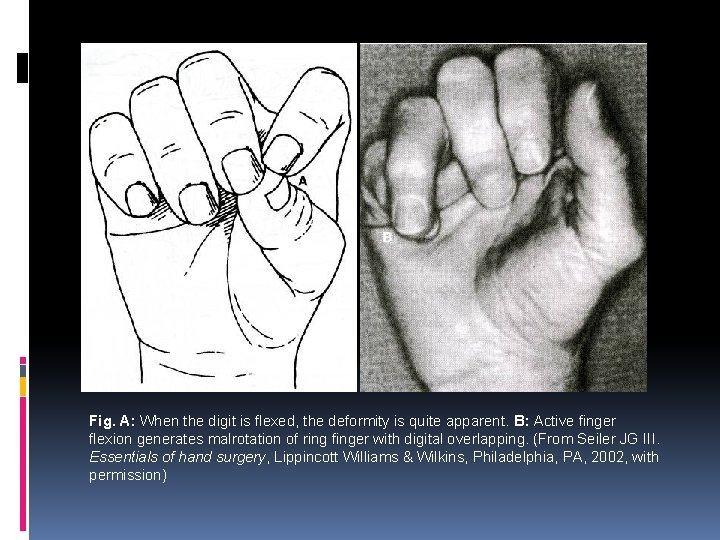 Fig. A: When the digit is flexed, the deformity is quite apparent. B: Active