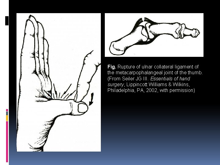 Fig. Rupture of ulnar collateral ligament of the metacarpophalangeal joint of the thumb. (From