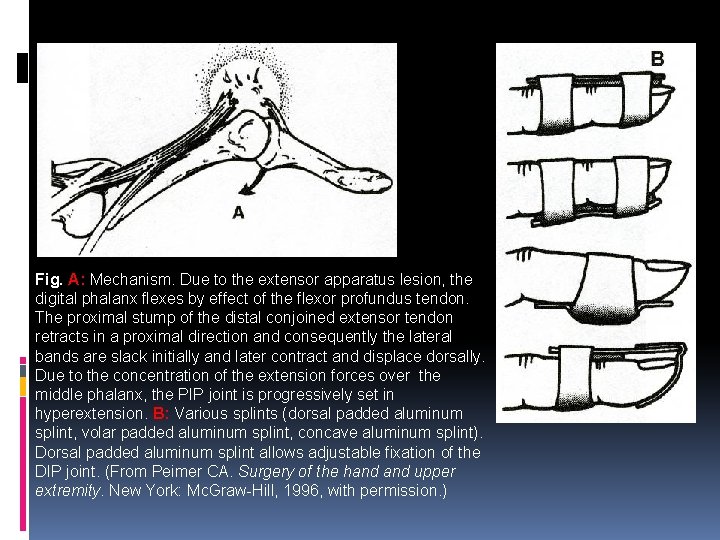 Fig. A: Mechanism. Due to the extensor apparatus lesion, the digital phalanx flexes by