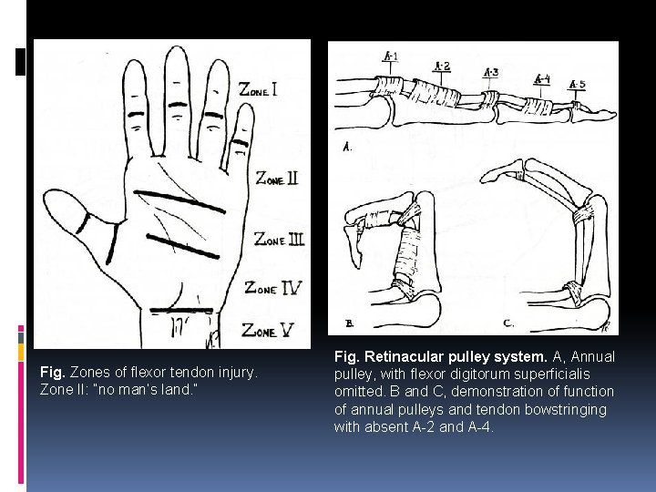 Fig. Zones of flexor tendon injury. Zone II: “no man’s land. ” Fig. Retinacular