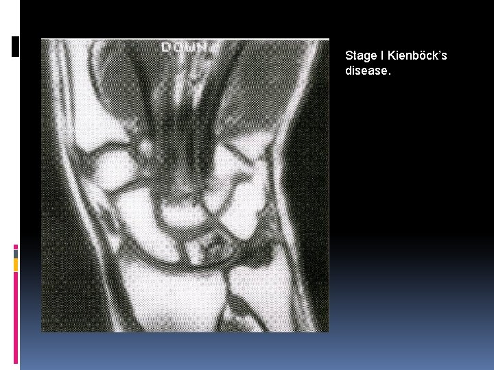 Stage I Kienböck’s disease. 