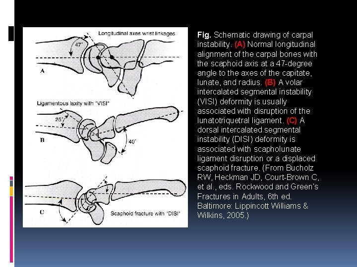 Fig. Schematic drawing of carpal instability. (A) Normal longitudinal alignment of the carpal bones