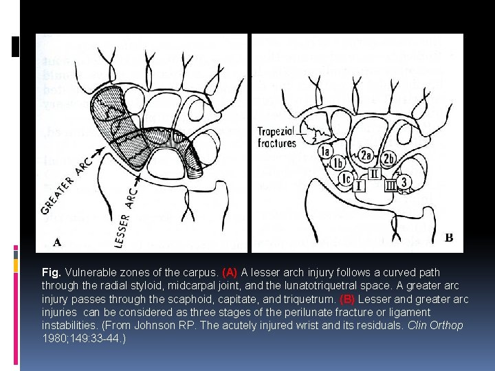 Fig. Vulnerable zones of the carpus. (A) A lesser arch injury follows a curved